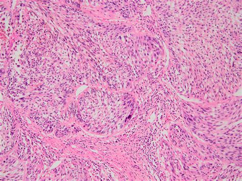spindle cell sarcoma pathology outlines